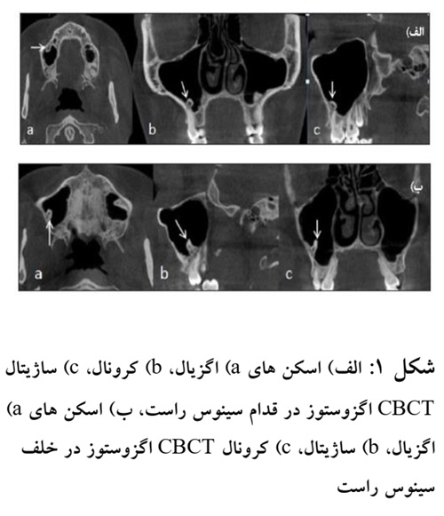 شكل :1الف) اسكن های )aاگزیال، )bکرونال، )cساژیتال CBCTاگزوستوز در قدام سینوس راست، ب) اسكن های )a اگزیال، )bساژیتال، )cکرونال CBCTاگزوستوز در خلف سینوس راست
