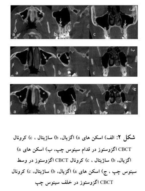 شكل :2الف) اسكن های )aاگزیال، )bساژیتال ، )cکرونال CBCTاگزوستوز در قدام سینوس چپ، ب) اسكن های )a اگزیال، )bساژیتال ، )cکرونال CBCTاگزوستوز در وسط سینوس چپ ، ج) اسكن های )aاگزیال، )bساژیتال، )cکرونال CBCTاگزوستوز در خلف سینوس چپ