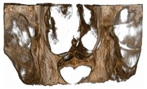 يافته راديوگرافيك كيست مجراي نازوپالاتين و مديريت جراحي آن: گزارش مورد