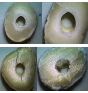 مقایسه استحکام باند push-out فایبر پست پس ازآماده سازی با لیزر و سند بلاست به کانال ریشه